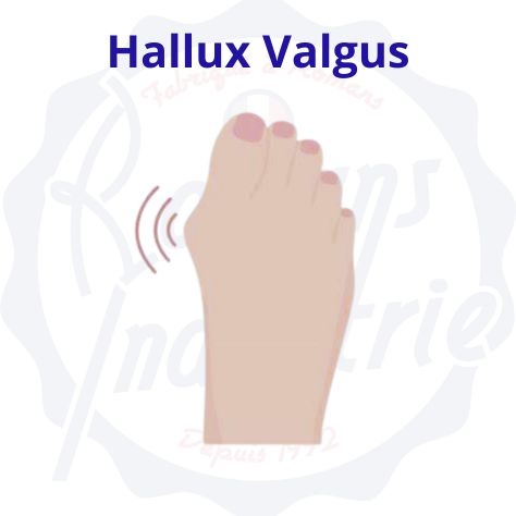 HALLUX VALGUS